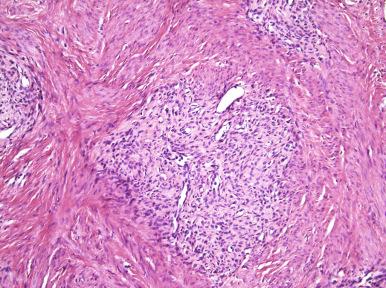 Fig. 20.8, Endometrial stromal sarcoma, low grade. A fibrous variant is shown.