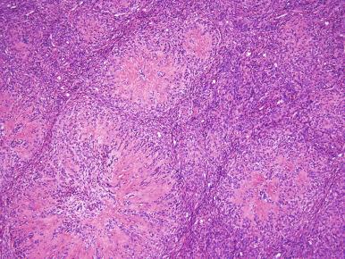 Fig. 20.9, Mixed endometrial stromal–smooth muscle tumor. Shown are nodules of smooth muscle differentiation with central prominent hyalinization (starburst pattern).