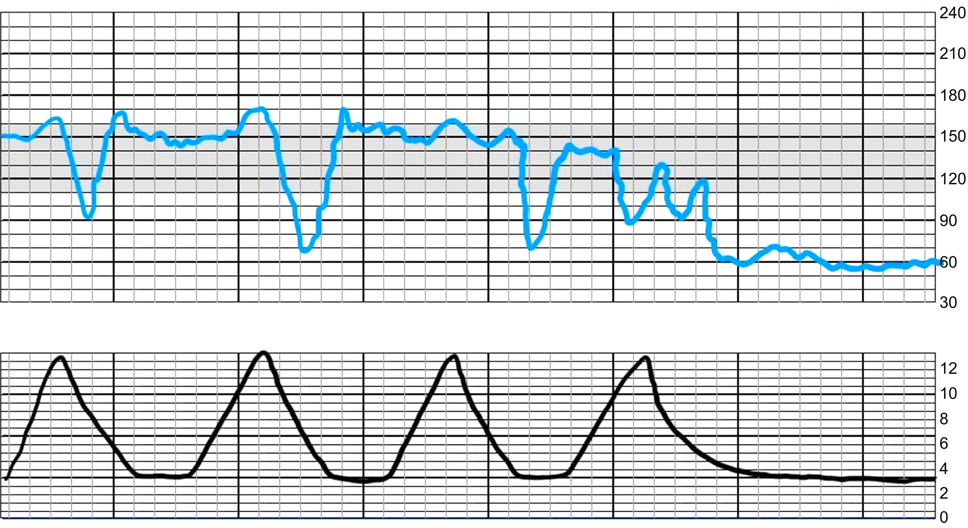 Fig. 16.2, Fetal heart rate changes are the most common signs of uterine rupture.