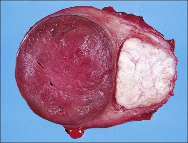 Figure 19.11, Red degeneration (necrobiosis). The cut surface of the leiomyoma on the left is red and more homogeneous, with loss of the whorled appearance.