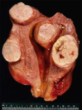 Figure 19.2, Multiple leiomyomas. On cut section, the tumors have a whorled white-tan surface that bulges above the normal myometrium. Three leiomyomas are intramural and one submucosal.