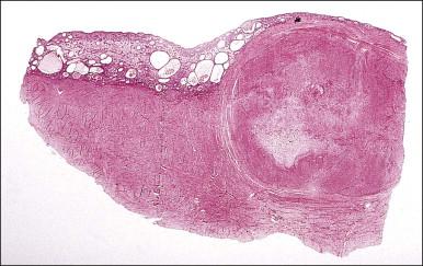 Figure 19.4, Submucosal leiomyoma. At this low magnification the sharp line of demarcation between the leiomyoma and the surrounding myometrium is clearly shown. The overlying endometrium is compressed and atrophic.