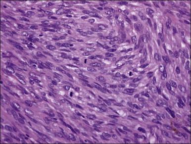 Figure 19.7, Mitotically active leiomyoma. Normal mitotic figures are seen in this otherwise ordinary leiomyoma. Nuclear atypia is lacking.