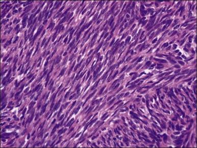 Figure 19.8, Cellular leiomyoma. The nuclear features are the same as those of a typical leiomyoma but the nuclei are more closely packed.