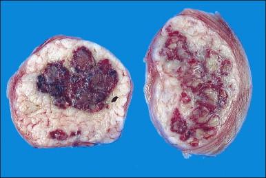 Figure 19.9, After treatment with GnRH agonists, the leiomyoma shows focal areas of hemorrhagic necrosis.