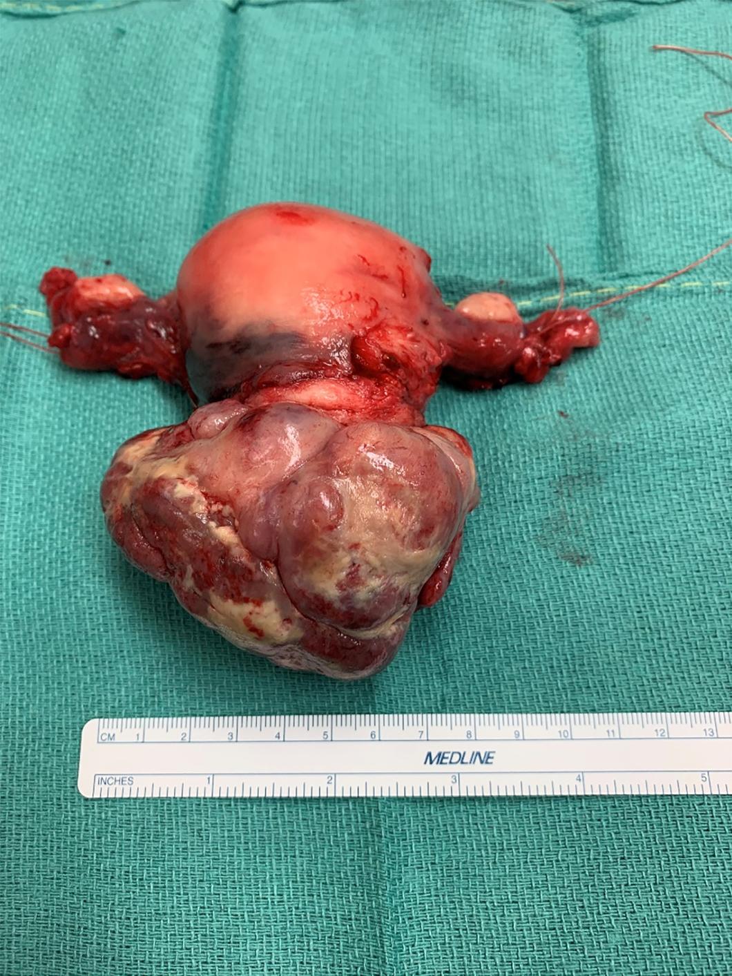 Fig. 11.1, Uterine carcinosarcoma prolapsing through cervix.