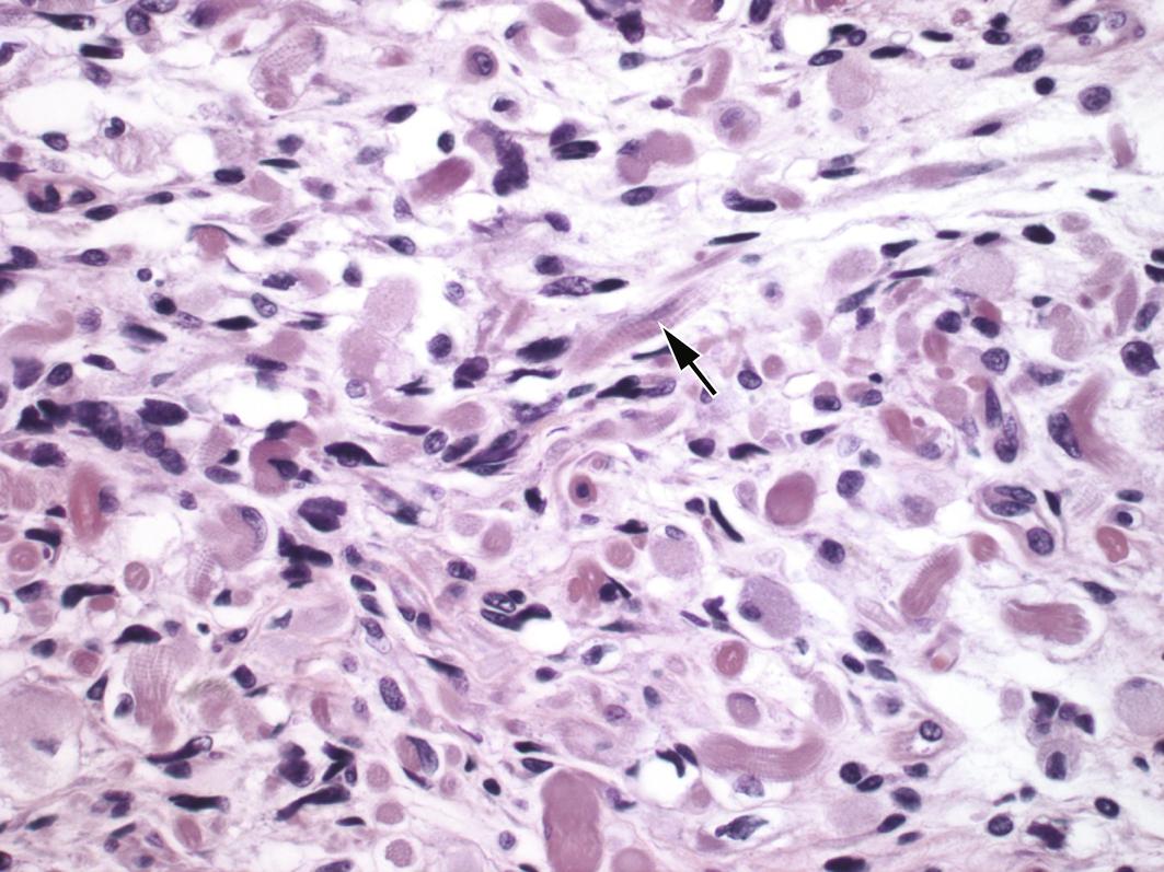 Fig. 11.4, Rhabdomyosarcoma component of a carcinosarcoma, with eosinophilic cytoplasm and cross striations ( arrow ).