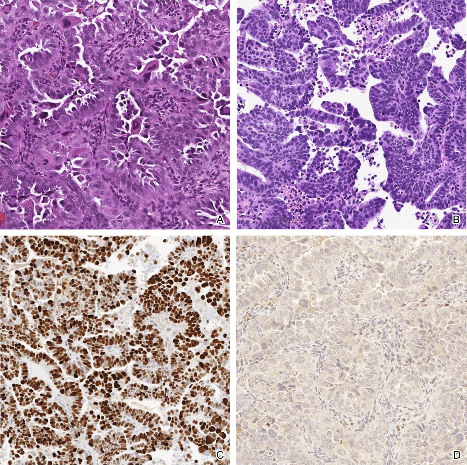 Fig. 12.1, (A) Glandular pattern of uterine serous carcinoma (USC) with marked cytologic atypia. (B) Papillary pattern of USC with marked nuclear heterochromasia. (C ) Immunohistochemistry for p53 showing an aberrant (strong, diffuse) staining pattern. (D) Immunohistochemistry for p53 showing an aberrant (null) staining pattern.