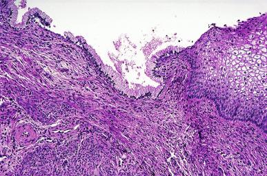 Figure 32.1, Transition zone of uterine cervix between exocervical squamous cells and endocervical mucin-producing glandular epithelium.