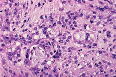 Figure 32.11, Predominantly Solid Form of Microglandular Hyperplasia.