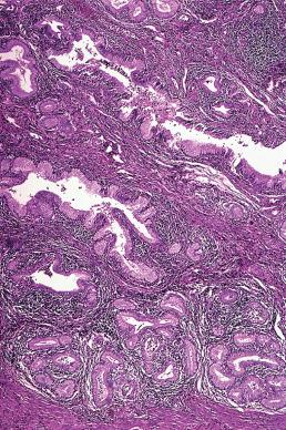 Figure 32.12, Diffuse Laminar Endocervical Hyperplasia.