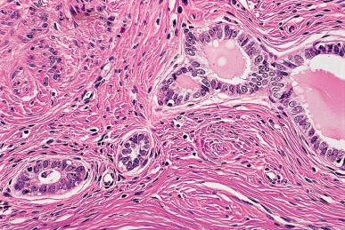 Figure 32.13, Hyperplastic mesonephric rests with mild atypia.