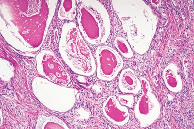 Figure 32.14, Mesonephric glands embedded within the stroma of the uterine cervix exhibiting cystic dilation. The presence of a dense eosinophilic secretion is characteristic.