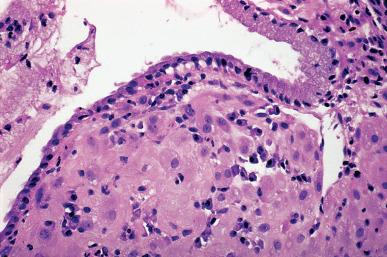 Figure 32.15, Focus of ectopic cervical decidual reaction.