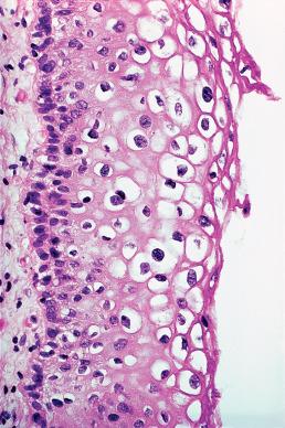 Figure 32.16, Koilocytotic changes in cervical squamous epithelium involved by LSIL (CIN1). These are diagnostic of HPV infection.