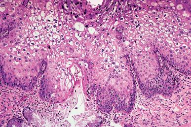 Figure 32.17, HPV-induced LSIL (CIN1) lesion characterized by acanthosis, papillomatosis, and koilocytotic changes.