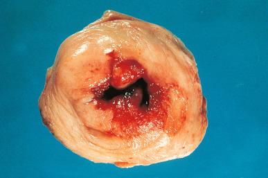 Figure 32.18, Gross appearance of HSIL (CIN2/3) extensively involving the uterine cervix.