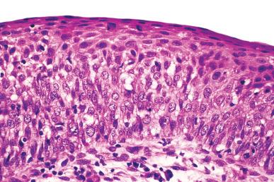 Figure 32.19, HSIL (CIN 2/3). There is proliferation and atypia, with increased N:C ratio and loss of normal maturation.