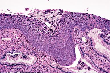 Figure 32.20, Extensive involvement by HSIL (CIN2/3) of surface epithelium and glands of endocervix.