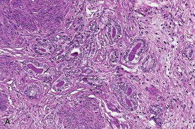 Figure 32.2, A and B , Florid mesonephric rests in endocervix. Note the eosinophilic inspissated secretion in the glandular lumen, an important diagnostic clue.