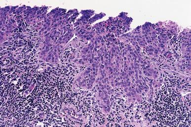 Figure 32.22, Low-power appearance of superficial invasive squamous cell carcinoma of cervix.