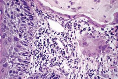 Figure 32.23, Small focus of invasion underlying HSIL (CIN2/3). Note the greater degree of squamous differentiation in the microinvasive component.