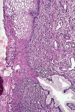 Figure 32.3, Squamous metaplasia of endocervix involving surface epithelium and glandular opening.