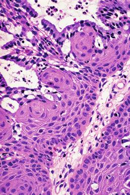 Figure 32.4, Complex pattern resulting from cervical squamous metaplasia. It may result in an overdiagnosis of squamous cell carcinoma.