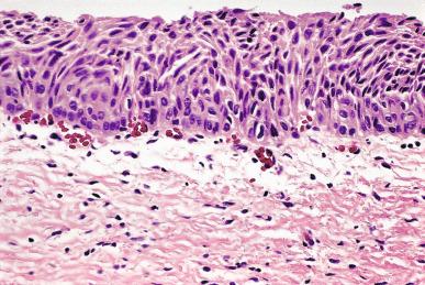 Figure 32.5, Typical appearance of transitional metaplasia, which lacks the nuclear atypia of HSIL (CIN2/3).