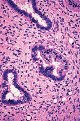 Figure 32.6, Tubal metaplasia of endocervix. Some of the lining cells are ciliated.