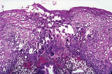 Figure 32.7, A and B , Low- and high-power appearance of herpes simplex infection of cervix. Multinucleated epithelial cells and intranuclear inclusions are evident in the high-power view.