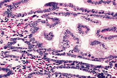 Figure 33.12, Mucinous Metaplasia of Endometrium.