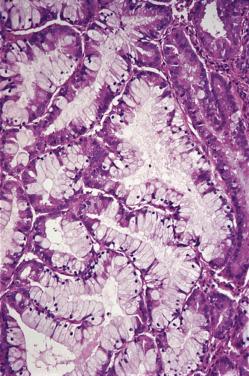 Figure 33.13, Clear Cell Metaplasia of Endometrium.