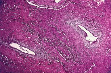 Figure 33.15, Intramyometrial foci of endometrial glands and stroma in adenomyosis.