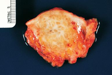 Figure 33.17, Gross appearance of endometriosis involving the anterior abdominal wall.