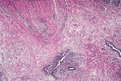 Figure 33.18, Endometriosis involving the umbilical region.