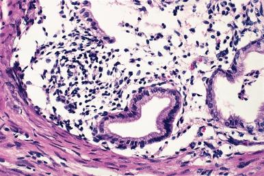 Figure 33.19, So-Called Endocervicosis.