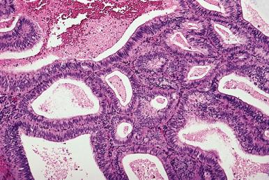 Figure 33.20, Endometrial Hyperplasia Without Atypia.