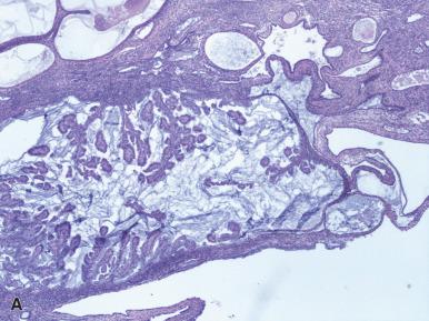 Figure 33.22, Papillary Proliferation of the Endometrium (PPE).