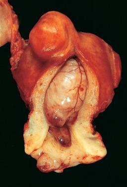 Figure 33.23, Huge Endometrial Polyp Filling the Endometrial Cavity.