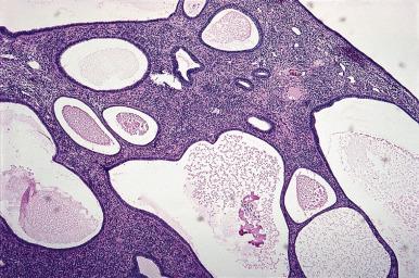 Figure 33.24, Low-power appearance of endometrial polyp showing cystically dilated glands and a fibrous stroma with thick-walled vessels.