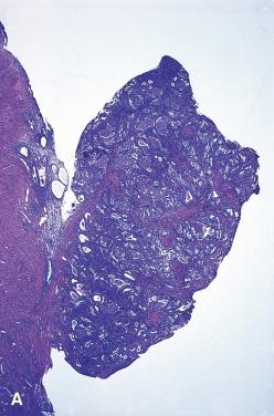 Figure 33.27, A and B, Whole-mount and high-power appearance of atypical polypoid adenomyoma. Note the glandular architectural complexity, metaplastic changes, and atypia.