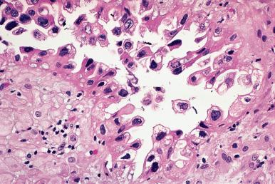 Figure 33.3, Arias-Stella Reaction in Endometrial Mucosa.