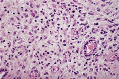 Figure 33.4, Typical appearance of endometrium after long-term administration of contraceptive pills. The glands are sparse and atrophic, whereas the stroma is prominent and has deciduoid features, reflecting the predominant progestin effect.