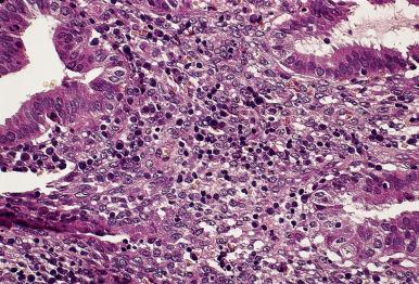 Figure 33.5, Chronic endometritis showing an inflammatory infiltrate rich in lymphocytes and plasma cells.