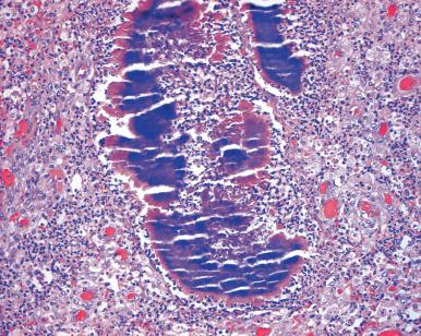 Figure 33.7, IUD-Related Uterine Actinomycosis.