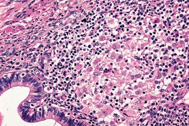 Figure 33.8, Noncaseating granuloma in endometrial mucosa consistent with sarcoidosis.