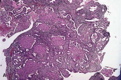 Figure 33.9, A and B, Squamous metaplasia of endometrium with morule formation.