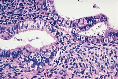 Figure 33.10, Tubal Metaplasia of Endometrial Mucosa.