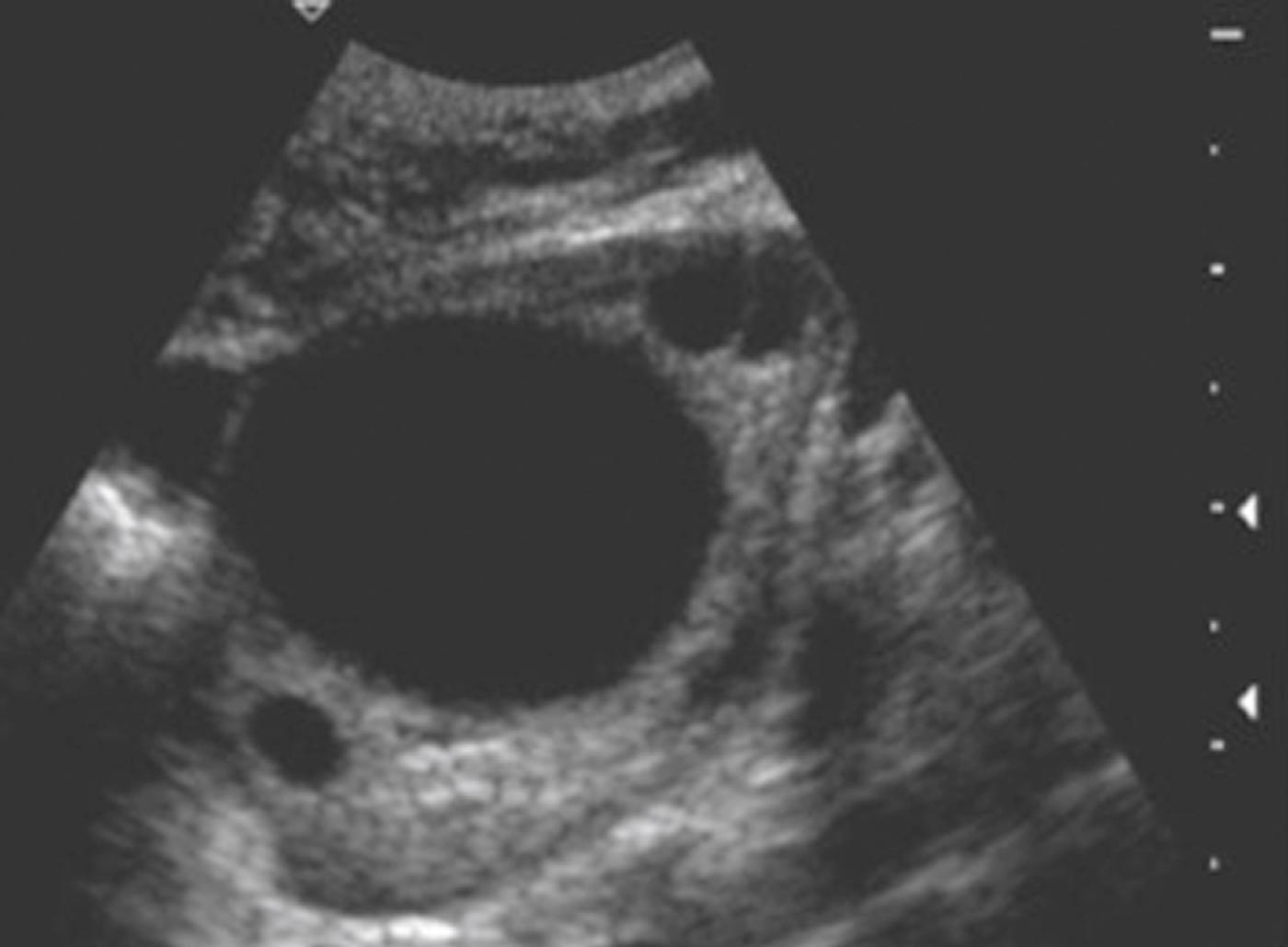 Figure 28.2, Simple ovarian cyst.